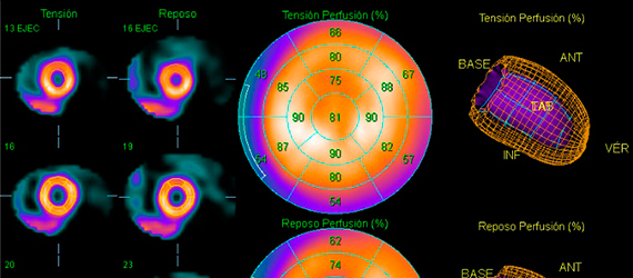 cardiología Nuclear